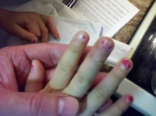 A smooshed finger